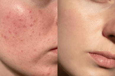 Jabón de cúrcuma anti acne-anti manchas oferta  2x1